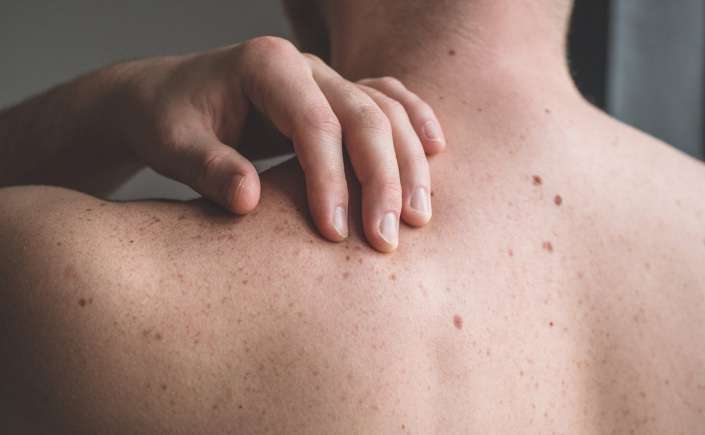 sintomas de câncer de pele