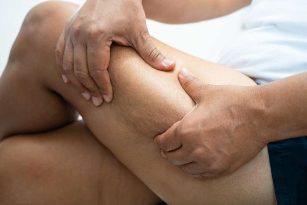 pessoa com gordura no membro inferior o que é lipedema