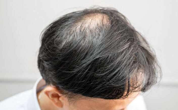 homem com falha de cabelo no topo da cabeça sinal de calvície masculina