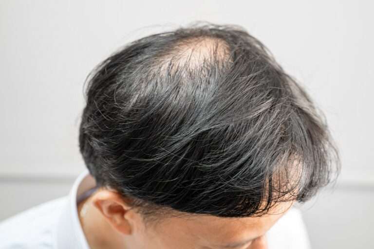 homem com falha de cabelo no topo da cabeça sinal de calvície masculina