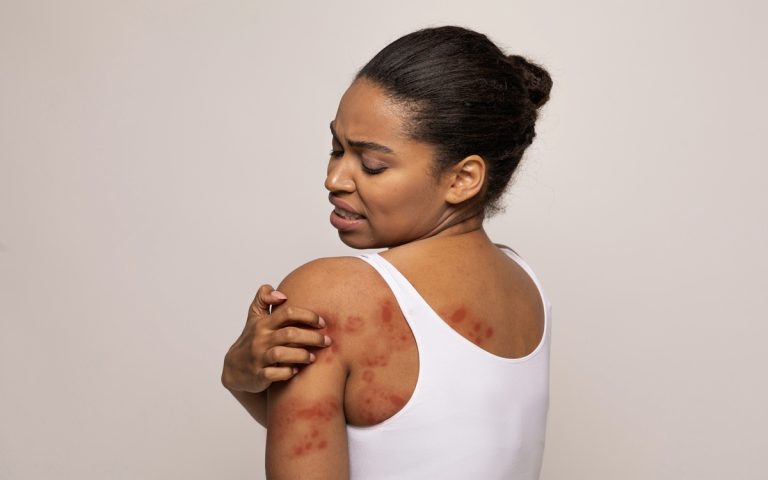 mulher com lesões na pele sintomas de herpes-zoster
